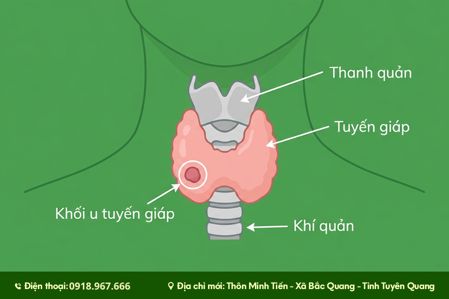u tuyến giáp và dấu hiệu cần theo dõi
