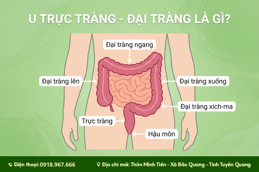 u trực tràng đại tràng và dấu hiệu cần theo dõi