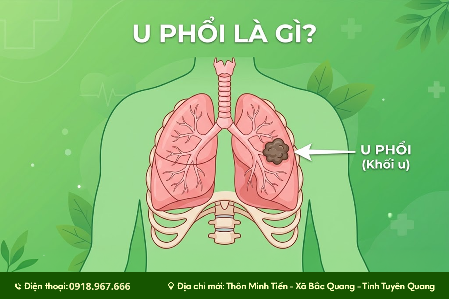 u phổi là gì, nguyên nhân, biểu hiện